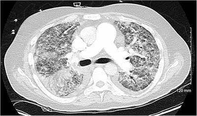 Case Report: Combined perioperative extracorporeal membrane oxygenation for acute heart failure caused by mitral regurgitation